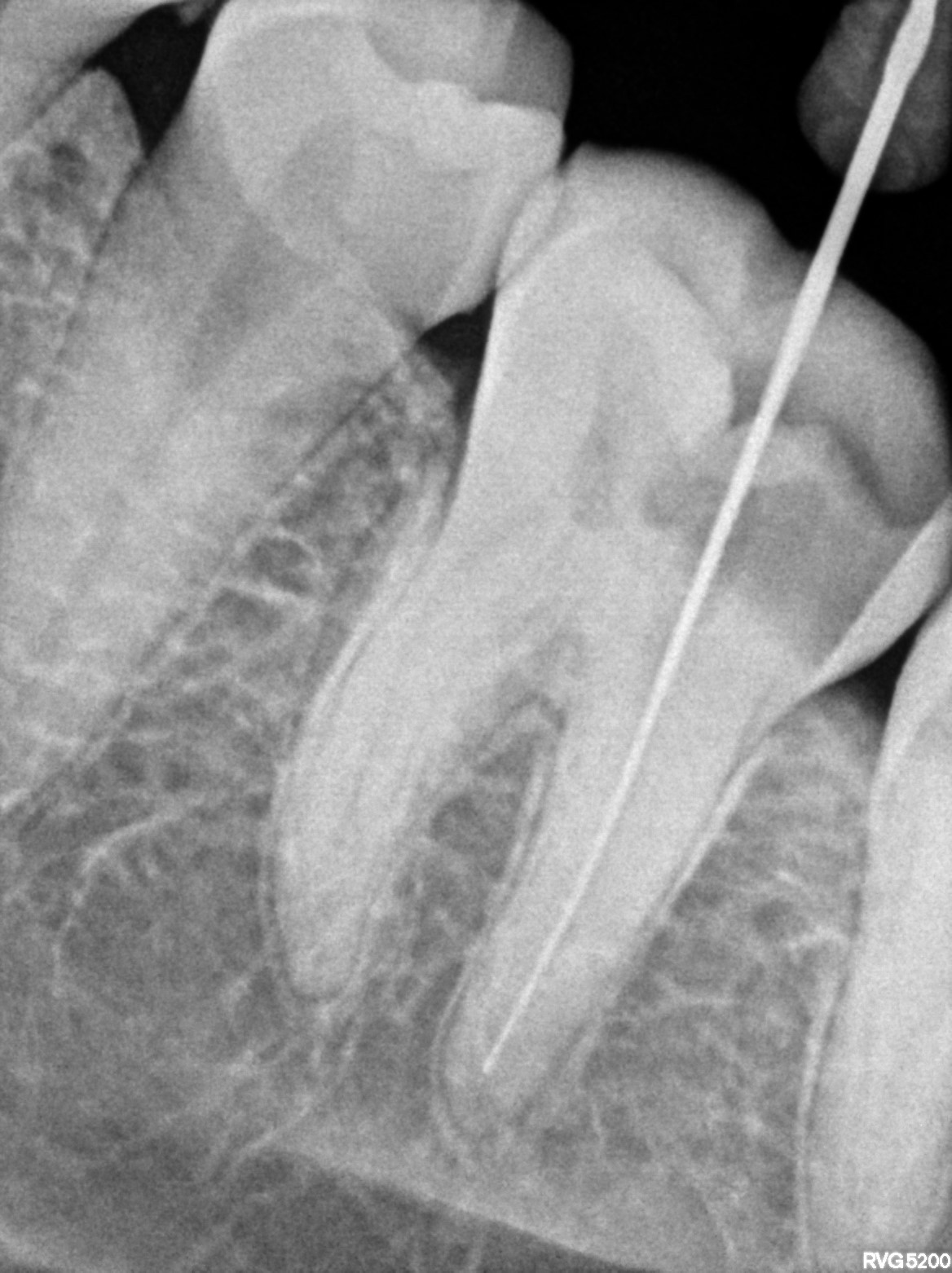 Dental X-ray